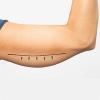 flabby skin
