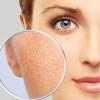 enlarged pores